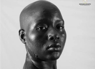 24 year old Adama Kamara got burnt during the war in Sierra Leone 24 year old Adama Kamara got burnt during the war in Sierra Leone