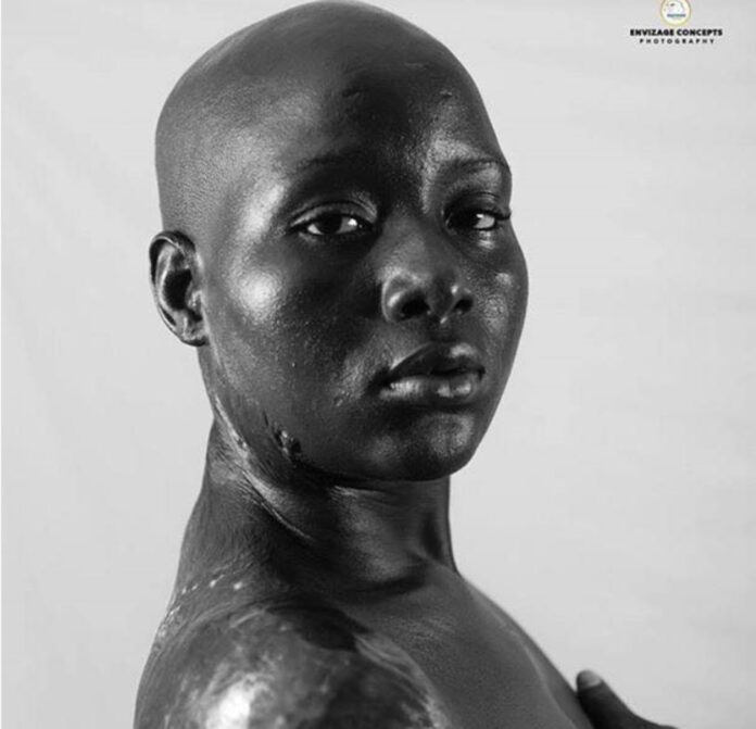 24 year old Adama Kamara got burnt during the war in Sierra Leone