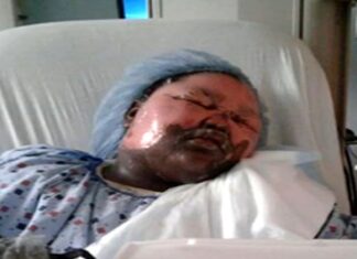 An 11 year old girl is in a stable condition when a friend pour a hot water on her during a sleep over 11-year-old girl burned by boiling water during sleepover: 'I can't be angry