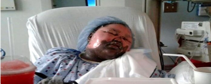 11-year-old girl burned by boiling water during sleepover_ 11-year-old girl burned by boiling water during sleepover: 'I can't be angry